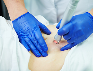 Precision Hair Removal